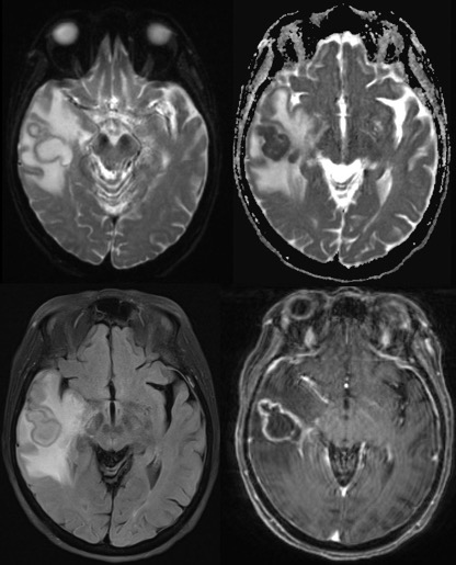 Figure 1. DWI, ADC, FLAIR and T1-post gadolinium MRI prior to the surgery showing right temporal lesion. 