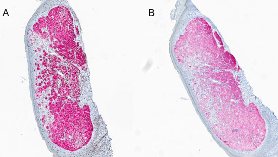 Figure 2: A - Melan A in red staining positive for the atypical melanocytes within the dermis.  B - HMB 45 staining positive for the atypical melanocytes.  