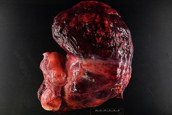 Figure 1: Total hysterectomy with bilateral salpingo-oophorectomy specimen showing a large, 22 cm, nodular, tan-brown tumor arising from the broad ligament. (Yellow arrows-tumor, black arrowhead-uterus, green arrow broad ligament)