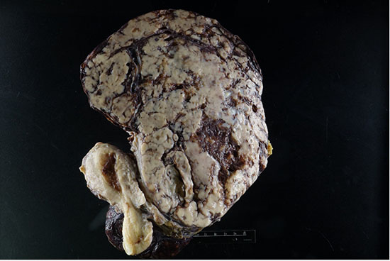 Figure 2: Cut section of the tumor showing tan-white to brown tumor with areas of hemorrhage and necrosis