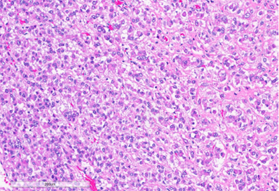 Figure 3: Tumor cells arranged in sheets and vague nests, with predominantly dense eosinophilic cytoplasm. (Hematoxylin and Eosin stained (10x)