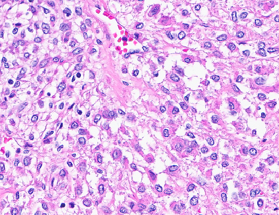 Figure 4: Tumor cells with clear cytoplasm. (Hematoxylin and Eosin stained (40x)