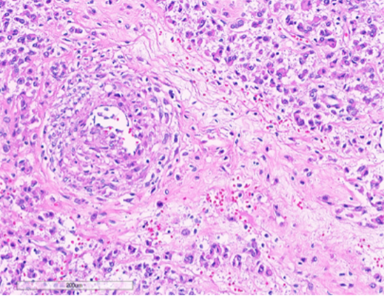 Figure 5: Tumor cells intimately associated with blood vessels. (Hematoxylin and Eosin stained (10x)