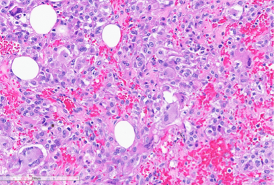Figure 6: Foci of tumor with intermediate grade nuclear atypia with occasional multinucleated tumor giant cells (bottom left, black arrow) and bizarre cells with hyperchromatic nuclei (green arrows). (Hematoxylin and Eosin stained (20x)