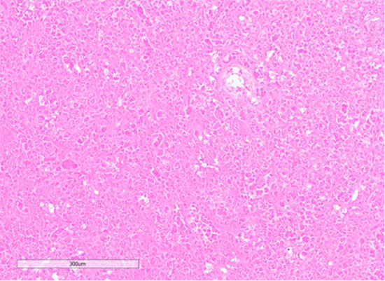 Figure 7: Section showing areas of tumor cell necrosis (Hematoxylin and Eosin stained (10x)