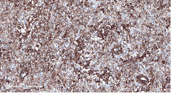 Figure 8: Tumor cells showing positive staining with desmin (20x)
