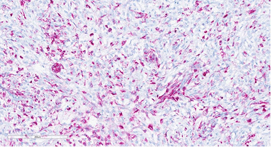 Figure 9: Tumor cells showing positive staining with HMB45 (20x)