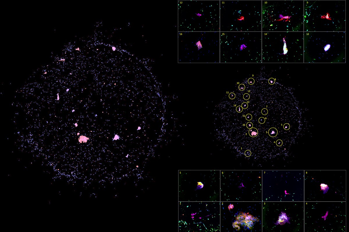 The cells in bronchoalveolar lavage fluid (BALF) were collected from wild-type C57BL6 mice treated with LPS plus mechanical ventilation (MV). The cells were stained, cytocentrifuged and observed. The cells were stained with Zombie Red (Red), anti-MPO antibody (green) and DAPI (blue). We can observe many cells with extruded DNA (blue) co-stained with MPO (green) and amine group protein (Zombie Red), which indicate neutrophil extracellular traps (NETs) formation. They look like planets and shooting stars ("NETosing" cells) orbiting among scattered blue stars (nucleus of BAL cells) in the galaxy space. We hypothesize that NETs formation is associated in the development of two-hit acute lung injury induced by LPS plus MV.